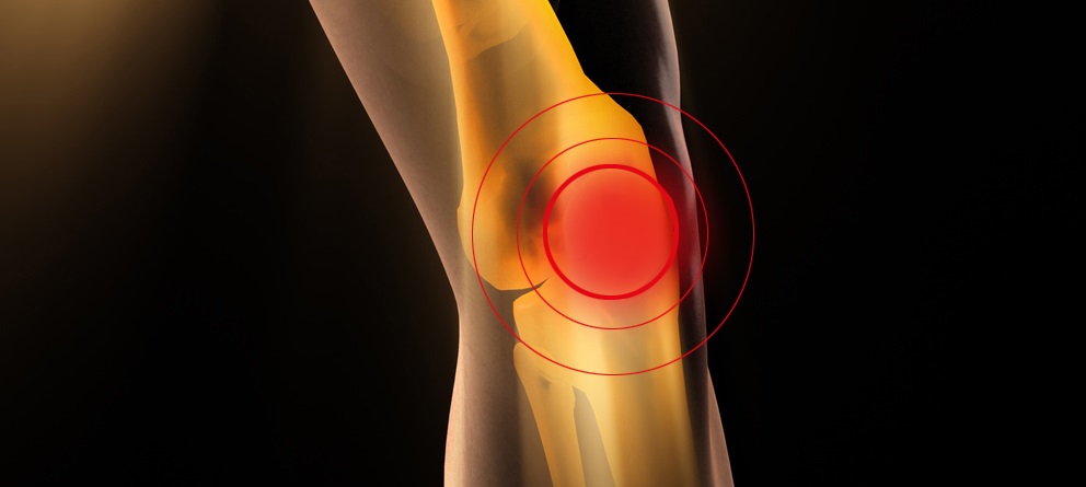 © Fotolia Fachtag Arthrose Knie